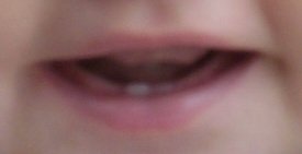 2010-07-29 - Second Tooth
