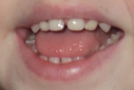 2012-02-11 - Mess Of Teeth