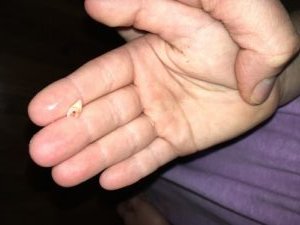 2017-10-12 - Lost Tooth